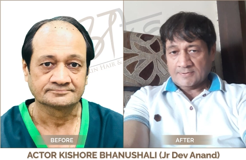 Celebrity Hair Transplant