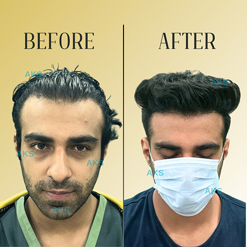 AKS clinic Before and After 9