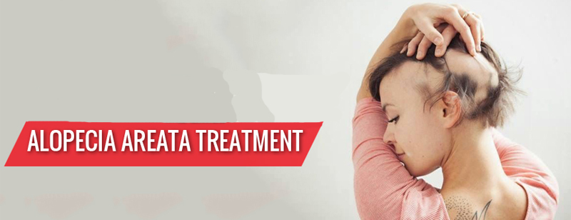 How Alopecia Areata Can Be Treated
