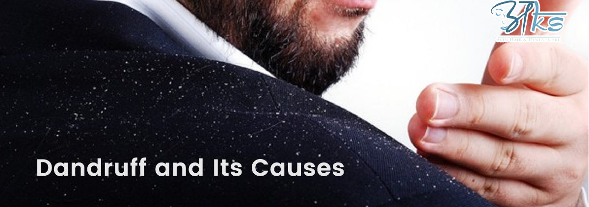 Dandruff And Its Causes