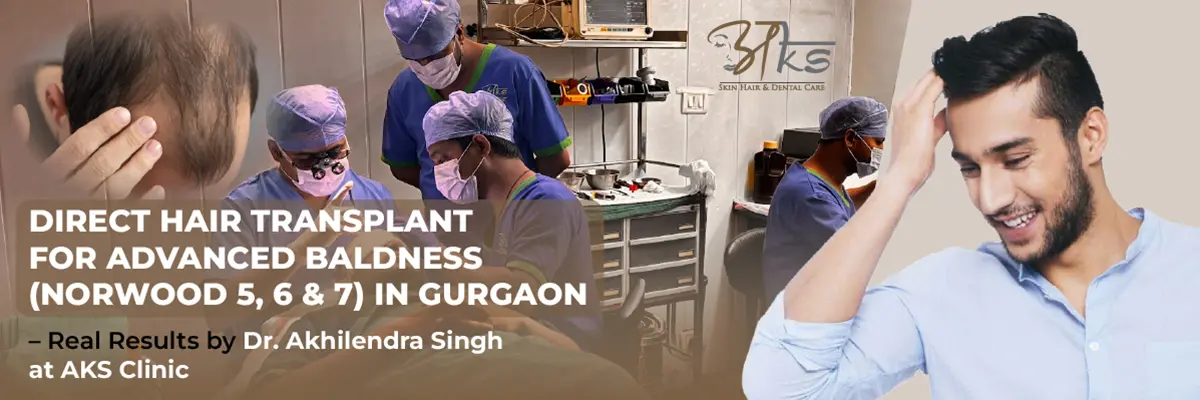 Direct Hair Transplant for Advanced Baldness (Grade 6-7)