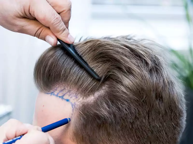 What are the advantages of the FUE Transplant Method at the AKS Clinic