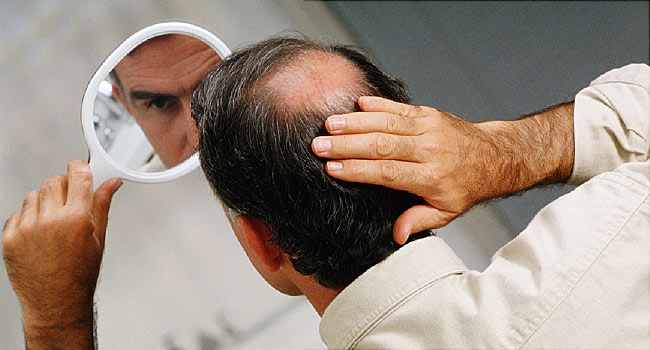 Know More About Pattern Hair Loss In Men