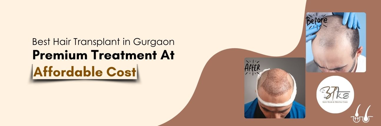 Hair Transplant Cost in Gurgaon, India