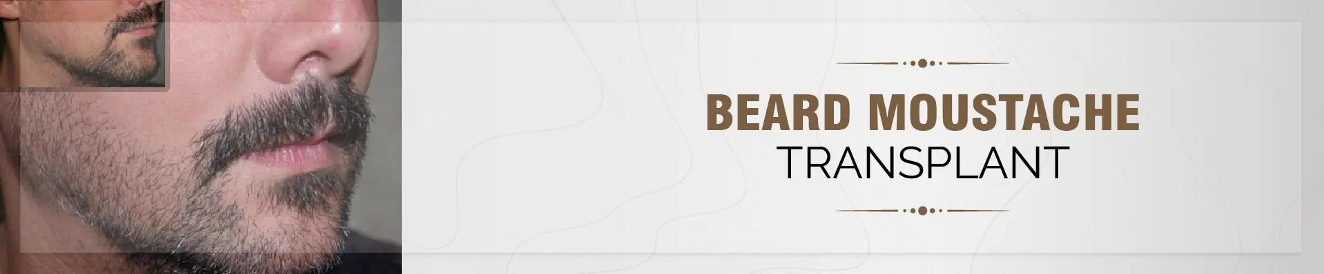 Beard Moustache Transplant