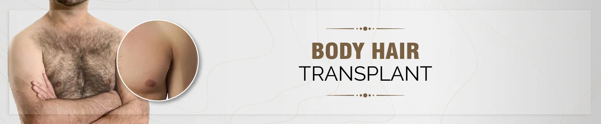 Body Hair Transplant