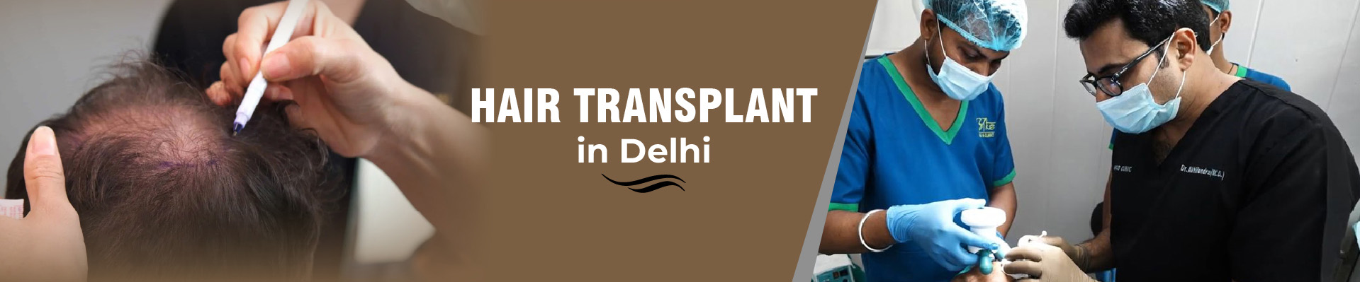 Hair Transplant Delhi
