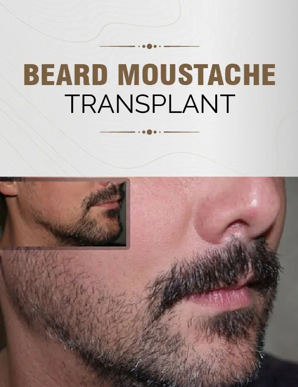 Beard Moustache Transplant