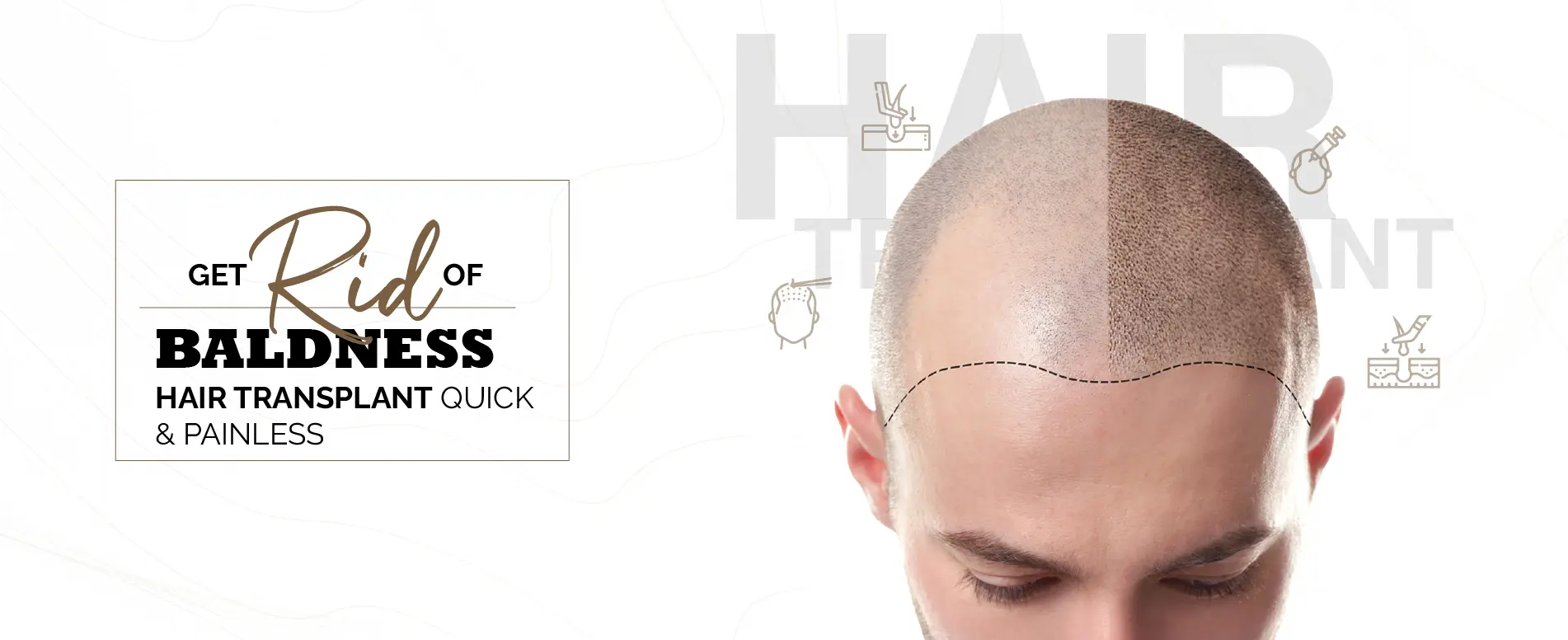 Direct Hair Transplant