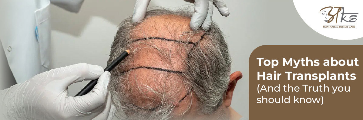 Myths About Hair Transplants